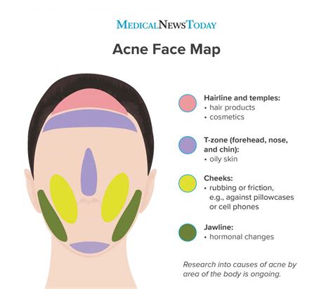 What Cause Acne On The Face